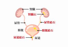 尿管結石の写真